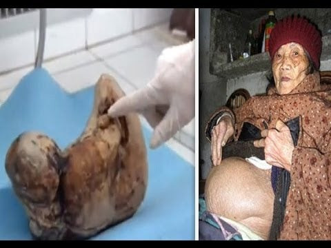 Ηλικιωμένη γυναίκα που κυοφορούσε το μωρό της επί 46 χρόνια τελικά το γέννησε αλλά είχε γίνει πέτρα